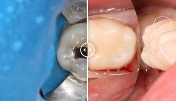 Лечение зубов