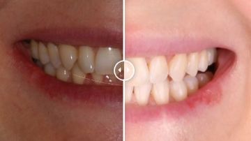 Лечение зубов