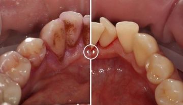 Лечение зубов