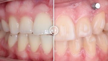 Лечение зубов