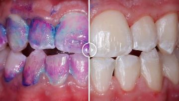 Лечение зубов