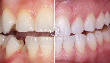 Лечение зубов