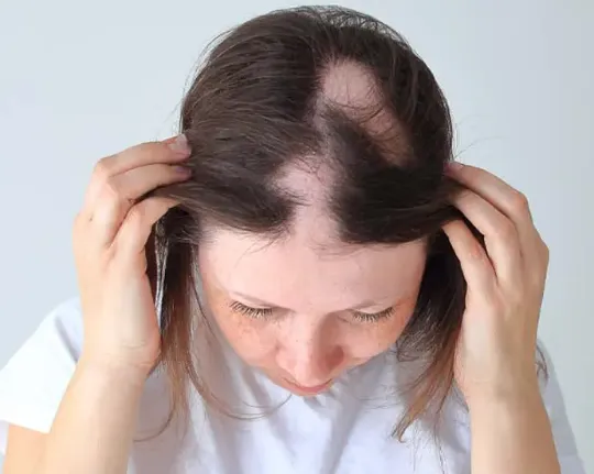 ალოპეცია