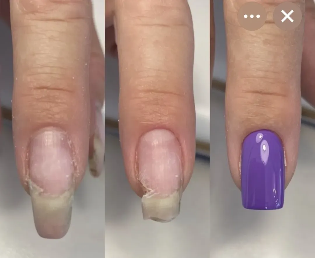 Ремонт ногтя