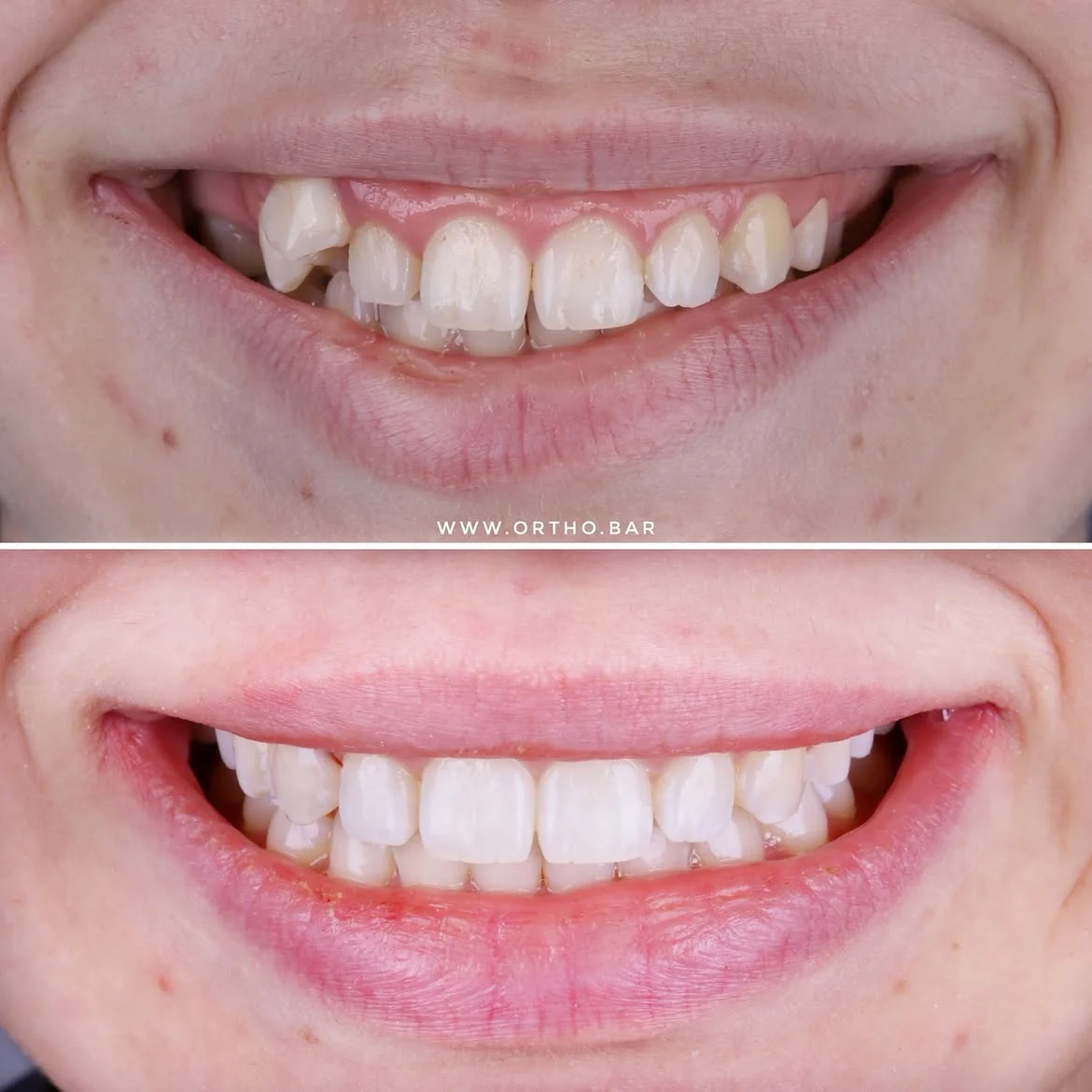 Лечение с удалением шестого зуба — кейс ORTHO.BAR
