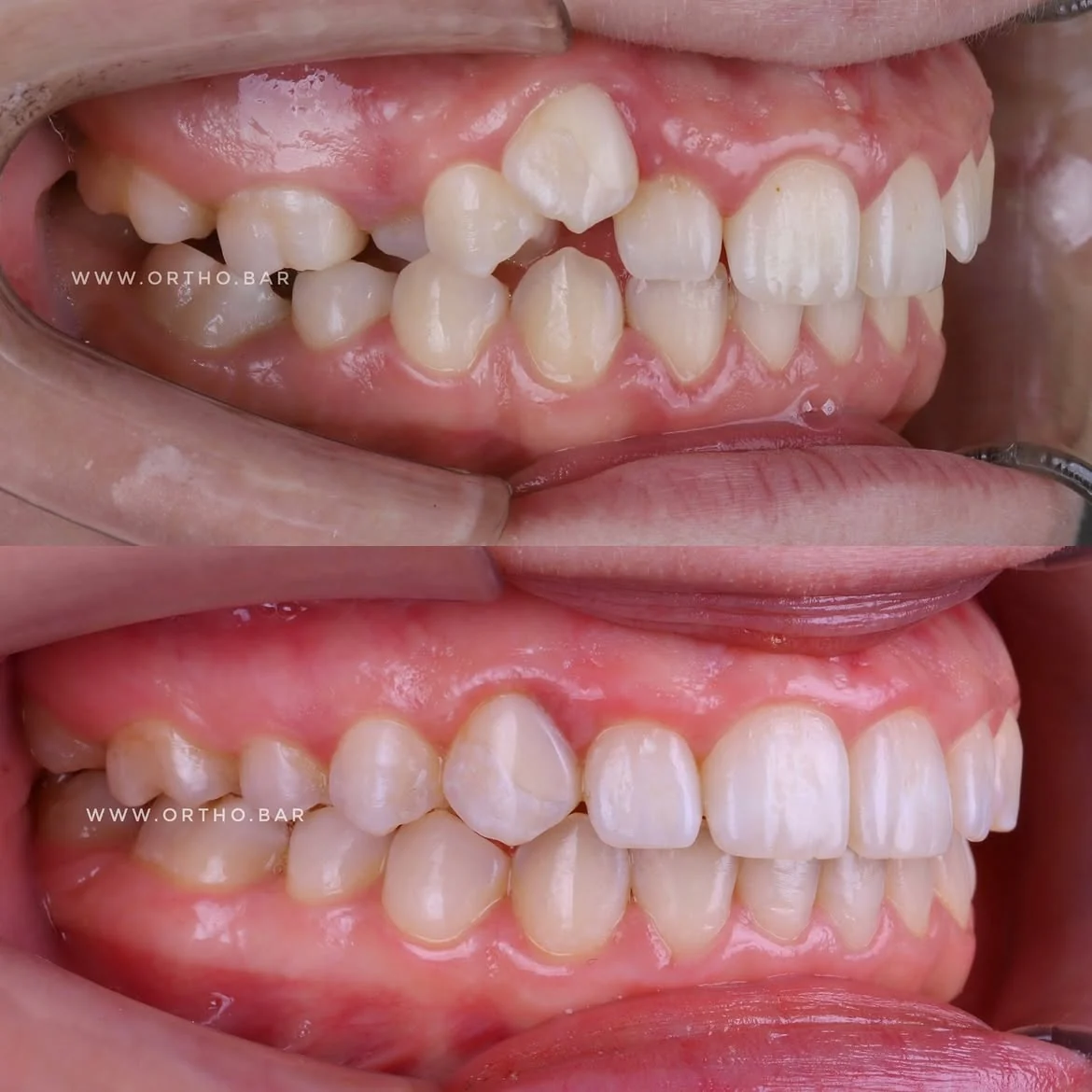 Лечение с удалением шестого зуба: фото 4 — ORTHO.BAR