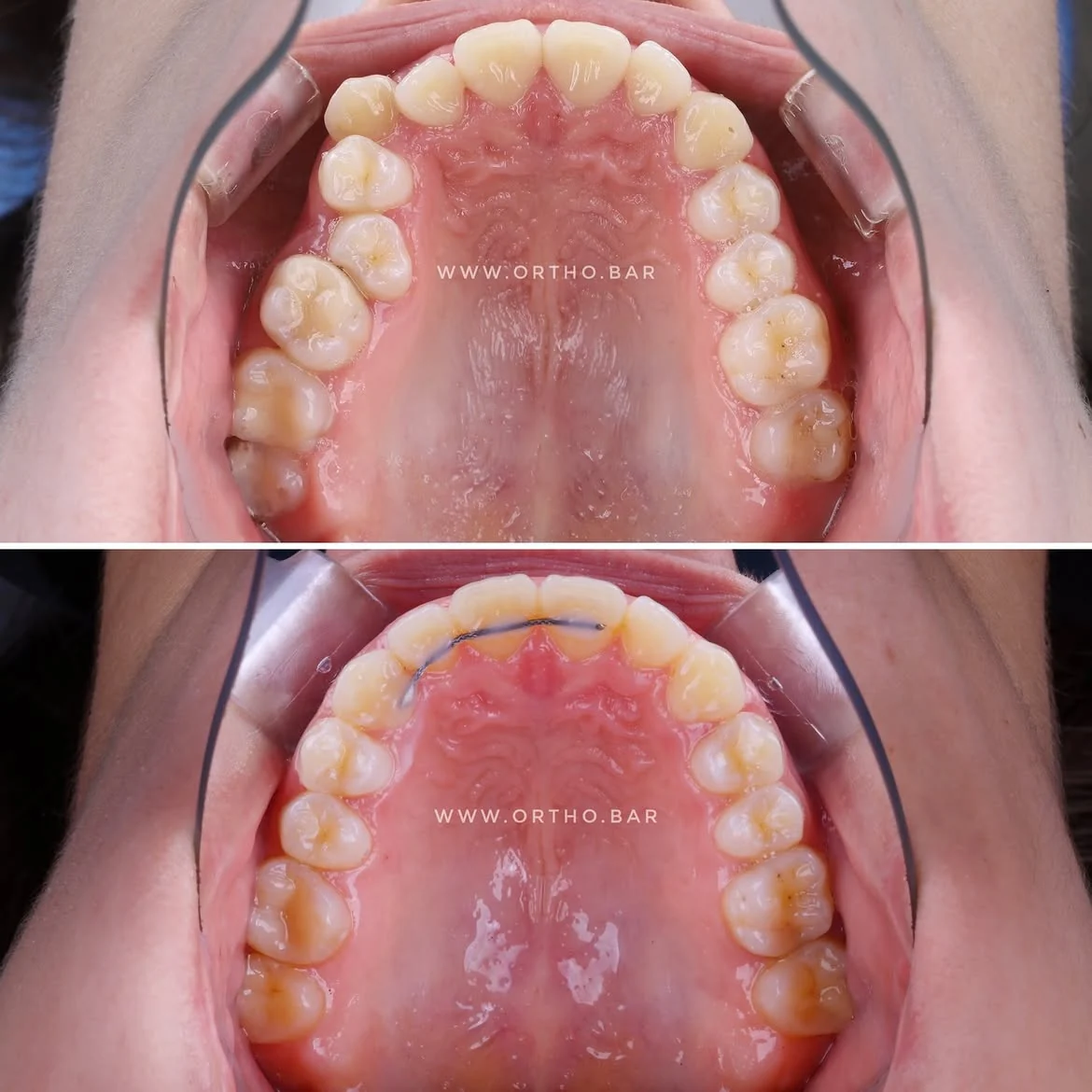 Лечение с удалением шестого зуба: фото 5 — ORTHO.BAR