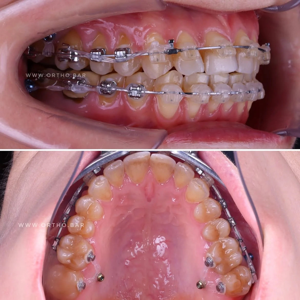 Подготовка к протезированию: фото 7 — ORTHO.BAR