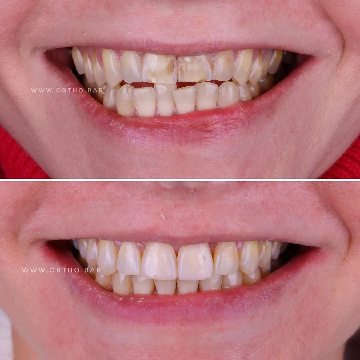 Подготовка к протезированию — кейс ORTHO.BAR