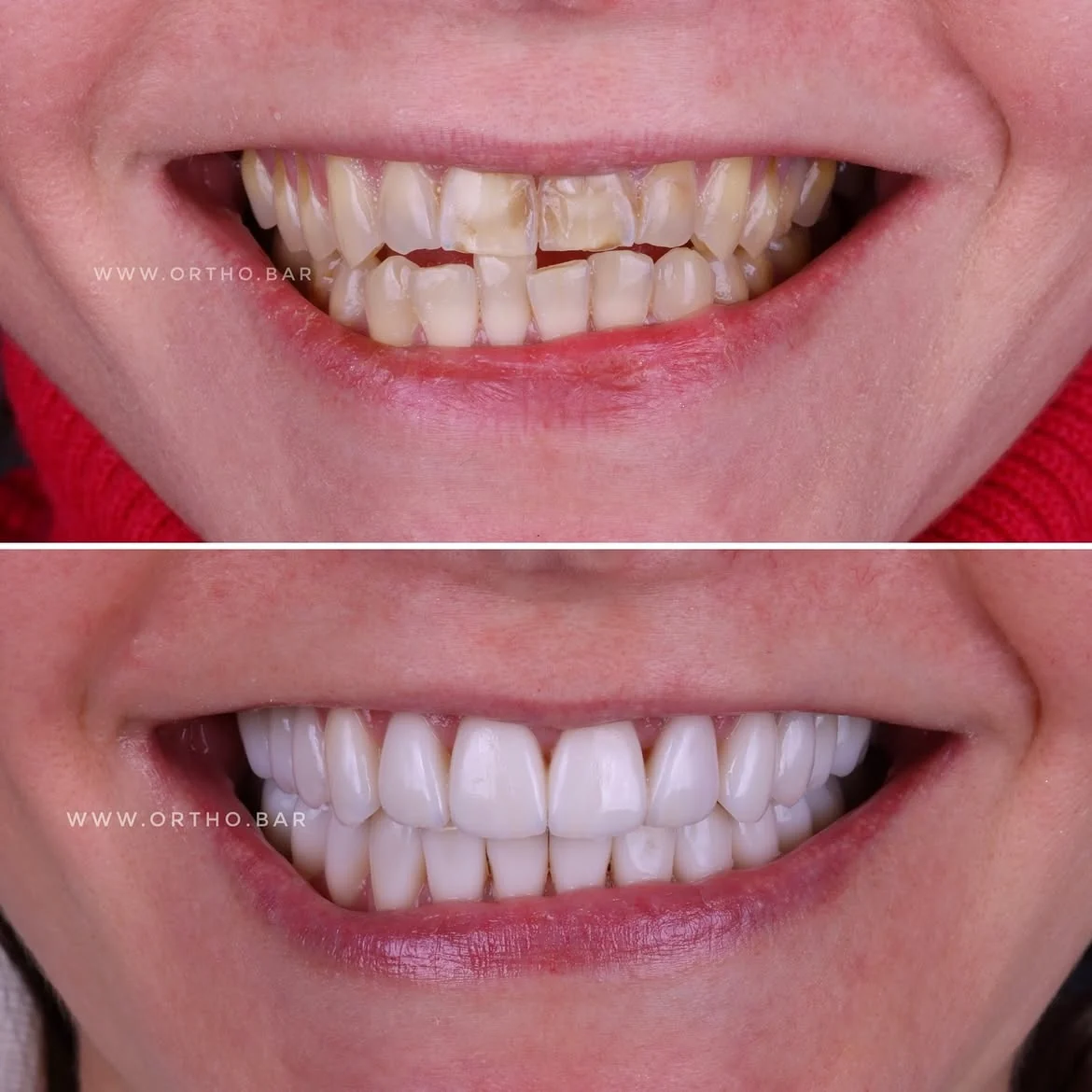 Подготовка к протезированию: фото 8 — ORTHO.BAR