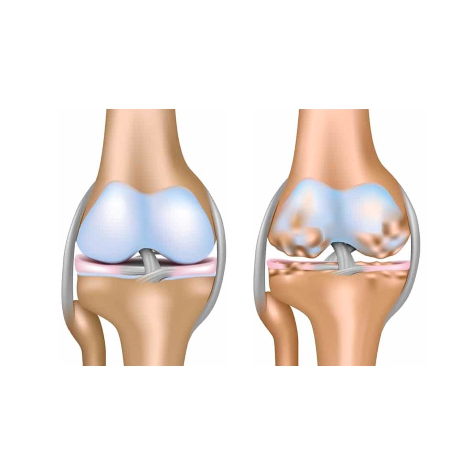 Остеопороз коленного сустава