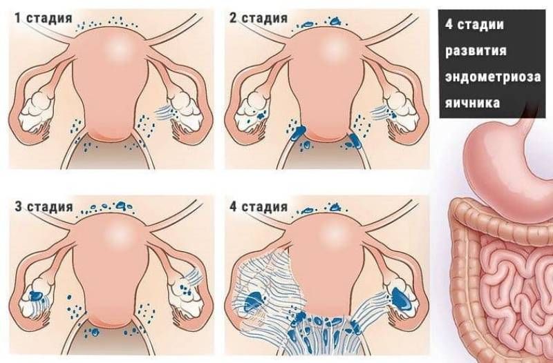 Эндометриоз матки как лечить после 40 лет. Эндометриоидные кисты яичников стадии. Стадии внутреннего эндометриоза.